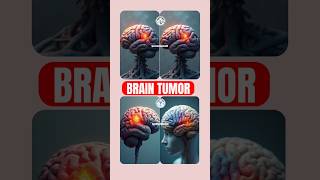 quotBrain Tumor Awareness Symptoms Diagnosis and Treatmentquot By OperationTheatreSKR BrainTumour [upl. by Tullus]