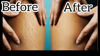 How to make a very effective Stretch Mark Oil at home [upl. by Aitam343]