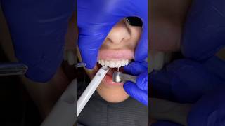 Cutting away temporary smile for final porcelain veneers 🦷 veneers dentalveneers porcelainveneer [upl. by Eliathan939]