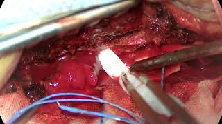 Surgical Resection of Spinal Angiolipoma Surgical Technique and Case Presentation [upl. by Elwee403]