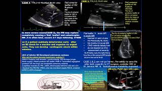 1 Test your skill Echo valve lesion [upl. by Trahurn]