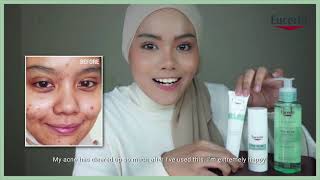 Clear Your Acne Effectively with Eucerin ProACNE Solution [upl. by Arednaxela]