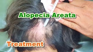 Alopecia Areata Treatment by ILS Intralesional Steroid Injections  Triamcinolone Acetonide [upl. by Jerrine25]