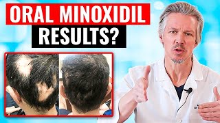 20000 PEOPLE TOOK ORAL MINOXIDIL AND THIS HAPPENED [upl. by Elyag941]