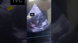 Echocardiography cardiac four chembur in heartvolvevideoheart [upl. by Kirkwood619]