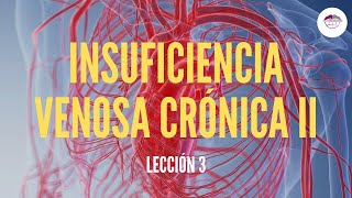 3 INSUFICIENCIA VENOSA CRÓNICA TRATAMIENTO PATOLOGÍA VASCULAR [upl. by Kciredohr]