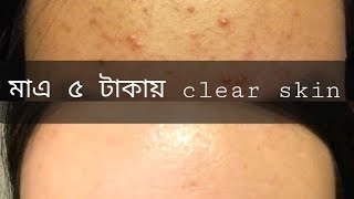 Fungal acne treatment in home with only 5 tk [upl. by Llerroj]