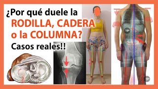 Dolor de Rodilla Espalda y Cadera 🛑 Descubre las Causas REALES con Casos REALES 🤯 [upl. by Ahsikal]