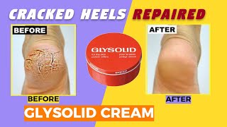 Glysolid Glycerin Cream Dry Skin Problem care Cracked heels home treatment how to use [upl. by Asira]