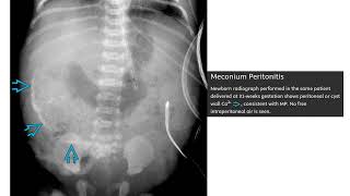 Meconium Peritonitis Imaging [upl. by Hamer]