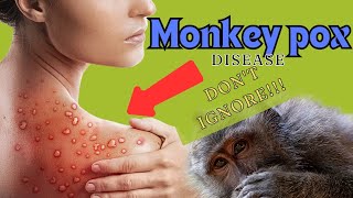 monkeypox disease  monkey pox outbreak 2024  Symptoms  Causes  Treatment [upl. by Jasmina]