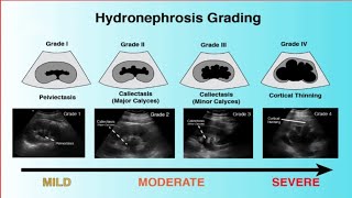 Hydronephrosis Ultrasound Grading [upl. by Adlesirk]