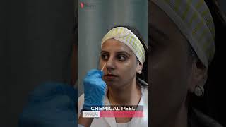 Chemical Peel For Active Acne amp Scars  HASH CLINICS [upl. by Glenn]