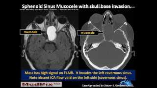 Sphenoid Sinus Mucous Retention Cyst vs Mucocele [upl. by Nylrak]