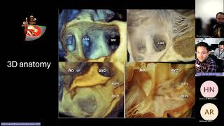 Pulmonary Vein assessment [upl. by Fatma902]