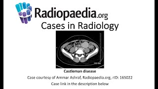 Castleman disease Radiopaediaorg Cases in Radiology [upl. by Aenet]