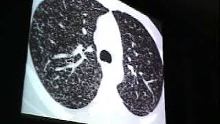 Interstitial lung disease CXR HRCT Airspace disease great [upl. by Ecylla744]