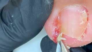 Treatment for Ingrown Toenails 016 satisfying nailsAlphanalis HCM [upl. by Airbmat691]