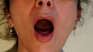 Video 10  Bulbar Palsy  Tongue fasciculations  Atteinte bulbaire  Fasciculations de la langue [upl. by Louth]