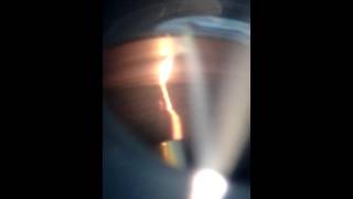 Gonioscopy video recorded using  Jaiz AIM [upl. by Ez]