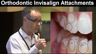 Role of Invisalign AttachmentsClear Aligner Systems in Orthodontic Treatment by Dr Mike Mew [upl. by Kcirrad]