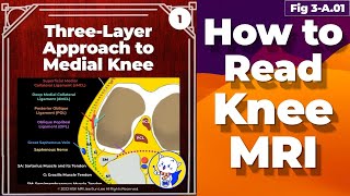 Fig 3A01 ThreeLayer Approach to Medial Knee [upl. by Gnohc]