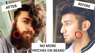 Patchy Beard ko Fix Kaise Kare  Solution to FIX PATCHY BEARD [upl. by Ozkum405]