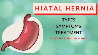 Hiatal Hernia Types Symptoms amp Treatment [upl. by Neelloj]