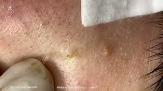 Big Cystic Acne Blackheads Extraction Blackheads amp Milia Whiteheads Removal Pimple Popping [upl. by Brendis]