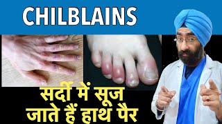 Chilblains  सर्दी में सूज जाते हैं हाथ पैर  Swollen hands and fingers in Winter  DrEducation [upl. by Weirick]