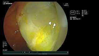 ruptured hydatid cyst in the common bile duct [upl. by Frolick]