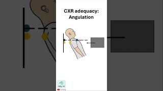 Chest xray adequacy ANGULATION [upl. by Syla825]