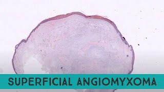 Superficial angiomyxoma cutaneous myxoma pathology dermpath dermatology dermatopathology [upl. by Nnylram]