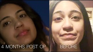 4 MONTHS POSTOP NOSE JOB UPDATE [upl. by December]