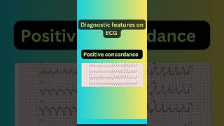 Ventricular Tachycardia  Diagnosis [upl. by Mollie]