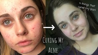 HOW I CLEARED MY ACNE  CYSTIC ACNE  Skincare Queen [upl. by Cannice]