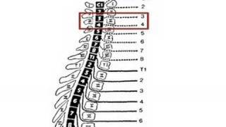 Levels of Function in Spinal Cord Injury [upl. by Hilde]