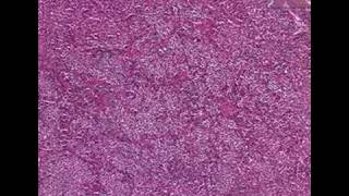 Histopathology PituitaryAcidophilic adenoma [upl. by Varien95]