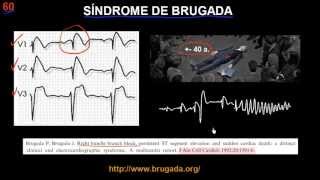 CURSO DE ELECTROCARDIOGRAFIA 60  SÍNDROME DE BRUGADA [upl. by Aicilef]