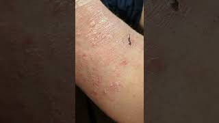 ASMR Psoriasis Flake Removal [upl. by Yoshi]