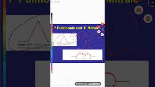 abnormal ECG part 1 [upl. by Eladnor]