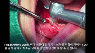 Bur selection tip For alveolopasty and osteoplasty by 드림팩토리치과 [upl. by Irreg600]