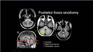 posterior cranial fossa anatomy in MRICT [upl. by Enirahtak]