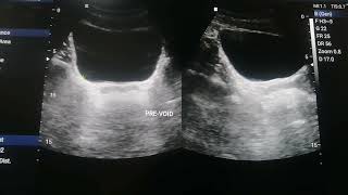 Normal Appearance of Urinary Bladder on Ultrasound and Calculating prevoid and Post  Void Volume [upl. by Ecyac]