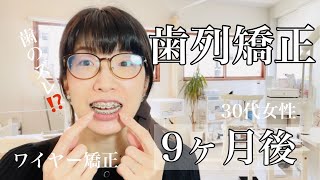 【歯列矯正9ヶ月後】30代女性・ワイヤー矯正・歯のズレ？トラブル編 [upl. by Nairoc]