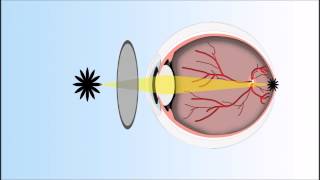 Presbyopia Explained Annimated Video [upl. by Ahsonek]