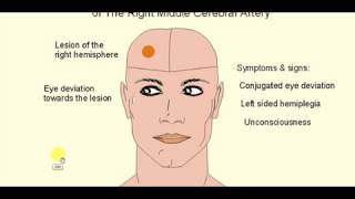 MEDICINE LECTURES  Neurology  STROKE  Part 2 [upl. by Justis399]