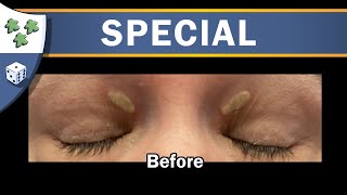 Ryan did a thing Episode 3 SelfSurgery Xanthelasma removal with Wartner Pen [upl. by Niggem]