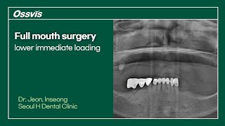 Clinical Case Full mouth surgery lower immediate loading [upl. by Anwat]