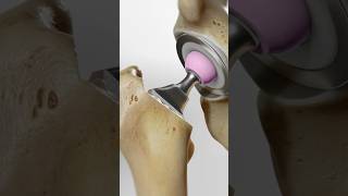 Total hip replacement explained 3D Animation [upl. by Sileray]